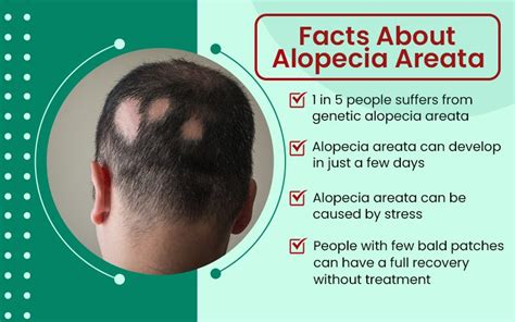 Homeopathic Alopecia Areata Treatment Cost in Mumbai, Maharashtra