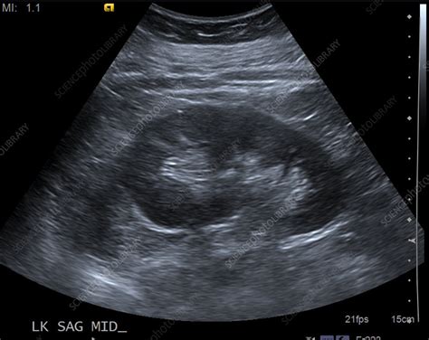 Kidney Ultrasound