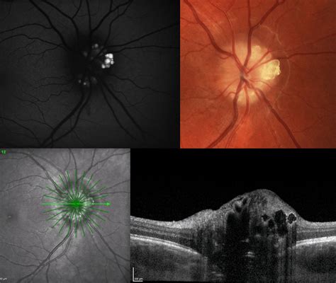 Optic Disc Drusen Prevalence 15 Times Higher in RP Patients