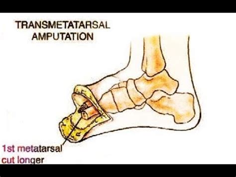 Transmetatarsal Amputation - YouTube