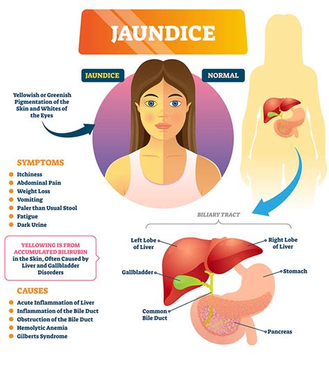 Jaundice In Children: Types, Causes, Symptoms, And Remedies