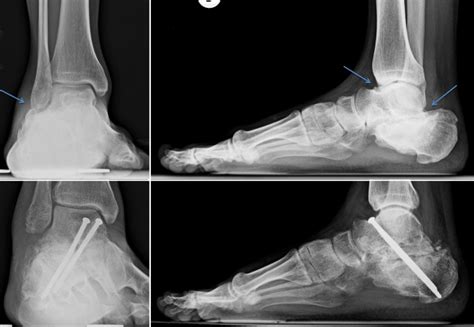 Arthrodesis – Foot and Ankle Institute