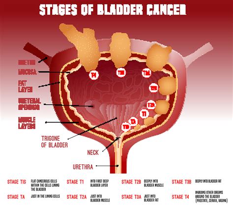 Bladder Cancer Image - AAUrology