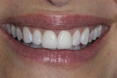 Composite Bonding vs Porcelain Veneers – which is better? - Enlighten ...