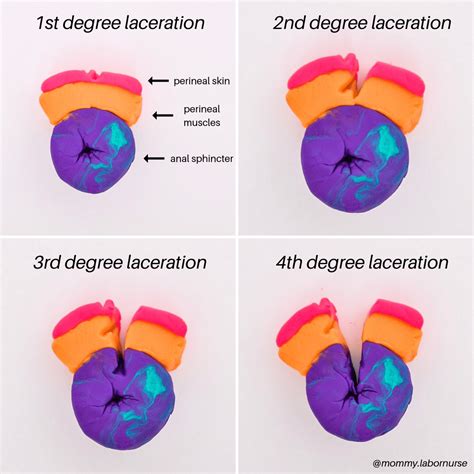 How To Prevent Tearing During Delivery: As Told By A Labor Nurse