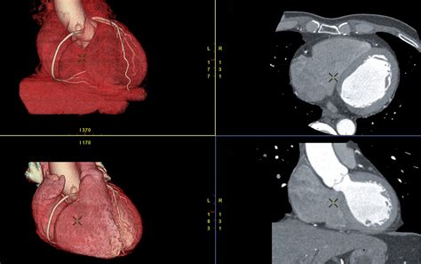 CT Coronary Angiogram — Hurstville Private Heart Centre · Cardiology ...