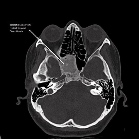 Ultimate Radiology : Case of the Day : Sclerotic Sphenoid lesion