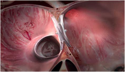 Gore Receives CE Mark For The Gore® CARDIOFORM ASD Occluder