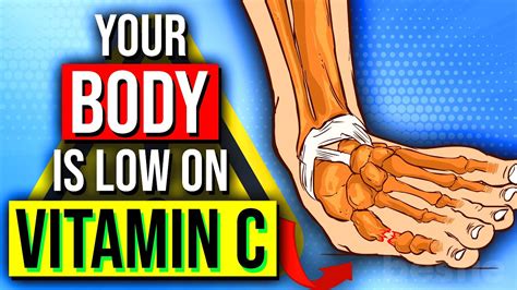 Vitamin C deficiency Symptoms that should never be ignored | Sports ...