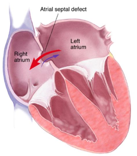 Atrial Septal Defect Anatomy