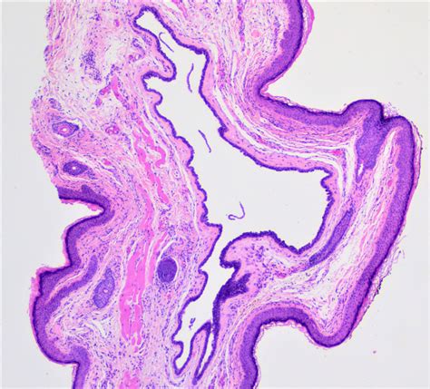 Pathology Outlines - Eyelid cysts