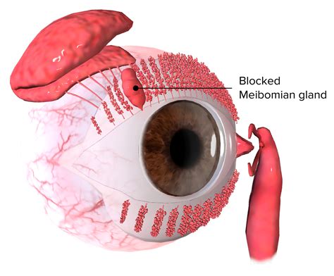 Chalazion (Clinical) | Concise Medical Knowledge