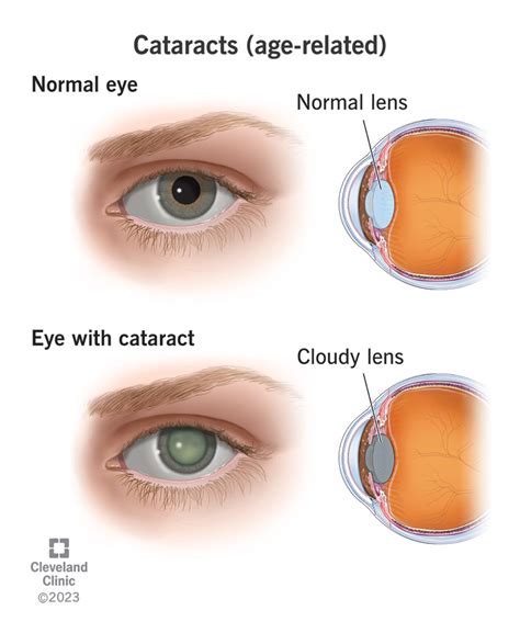 if the initial symptoms of cataracts are blurred and the front - 셀프정보