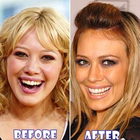 Hilary Duff Plastic Surgery Before and After Breast Implants, Nose Job ...