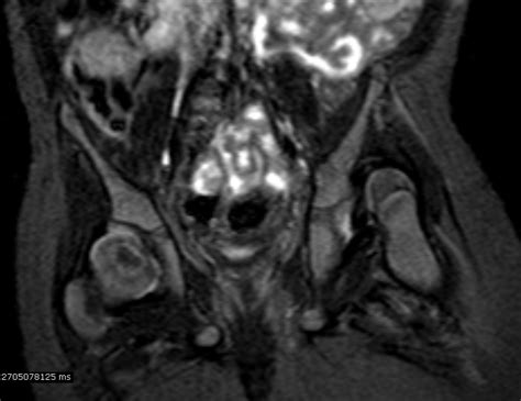 Developmental Hip Dysplasia-MRI - Sumer's Radiology Blog