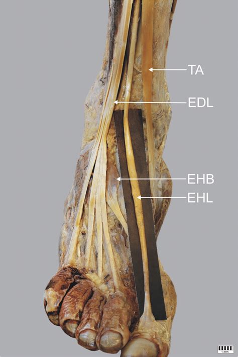 Extensor Hallucis Longus Muscle