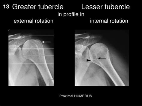 PPT - More upper extremity PowerPoint Presentation - ID:7050318