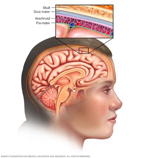 Meningioma - Symptoms and causes - Mayo Clinic