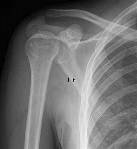 Rough trip: Scapula fracture | Radiology Key