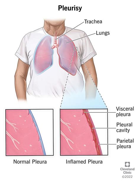 Top 9 what makes pleurisy flare up 2022