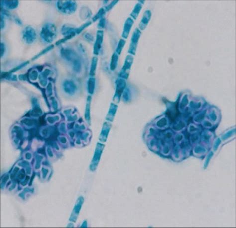 Trichosporon inkin and Trichosporon mucoides as unusual causes of white ...