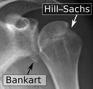 Hill Sachs Lesion - Physiopedia