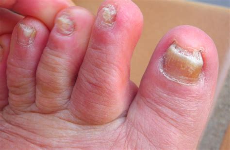 Toenail Fungus: Pictures, Treatment, Home Remedies & Medication