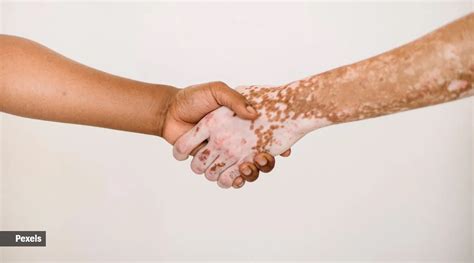 World Vitiligo Day: Know all about the condition, its symptoms, causes ...