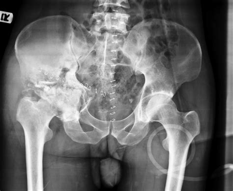 Pre‐op x‐ray shows the fracture of the right acetabulum and femoral ...