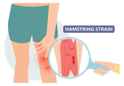 Hamstring Tear: Symptoms, Causes, Treatment, and More!: Elite Sports ...