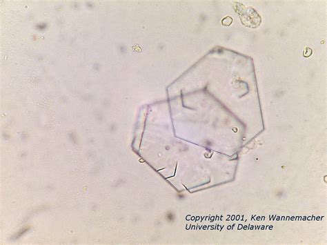 cystine crystals in urine sediment | Medical Laboratories