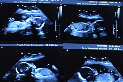 Canadian couple expecting identical quadruplets, all girls