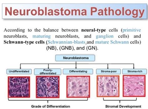 Pin on Neuroblastoma