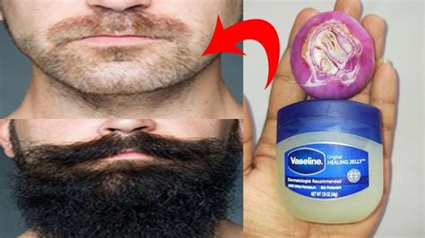 How to grow beard faster naturally at home with onion and vaseline ...