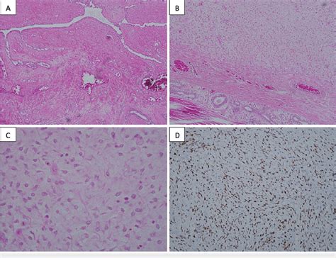 Histopathological examination from the left mastectomy A) Scattered ...