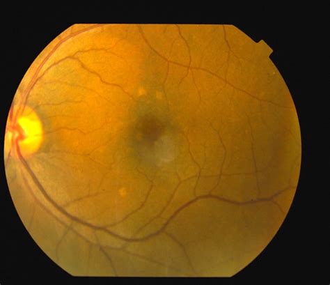 Choroidal Hemangioma - Retina Image Bank