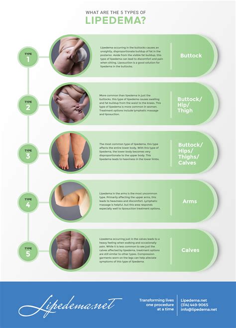 » Lipedema Definitions and Explanation - Lipedema