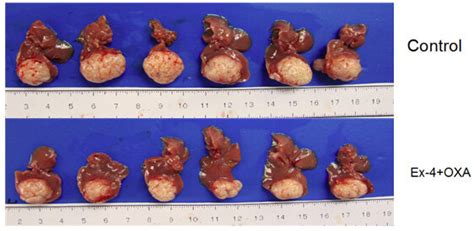 Stages Of Cancer Tumor Size