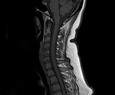 FLAIR MRI | FLAIR MRI Sequence Physics, Image and Pathology Appearance