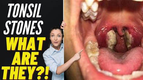 Tonsils Stone Removal, Causes & Treatment 2021 - YouTube