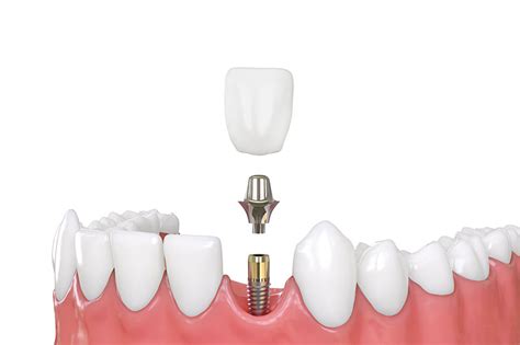 What are the Different Types of Dental Implants? - South Gables Dental