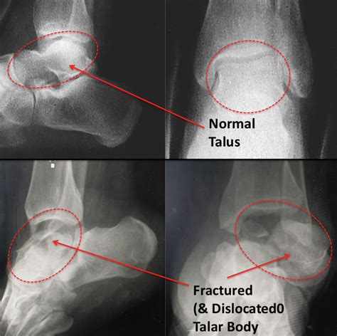 Talar Body Fracture - FootEducation