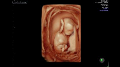 What Is A 4D Ultrasound Scan? Importance And How It Works