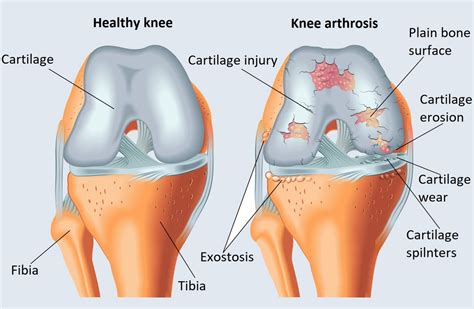 Chondromalacia patellae (cartilage softening) surgery - Medicover