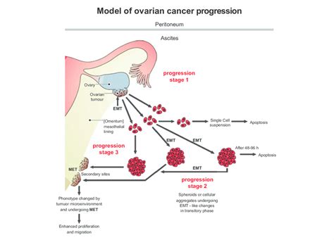 Pathophysiology Of Ovarian Cancer