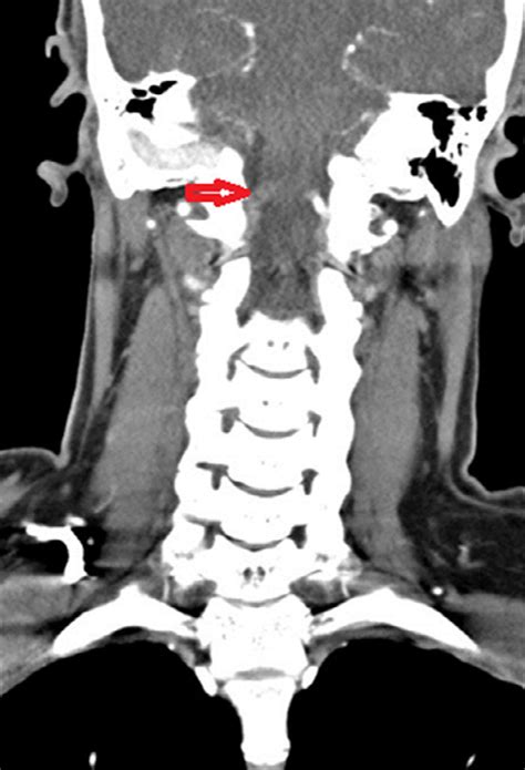 -CTA of the head and neck, showing a complete occlusion of the right ...