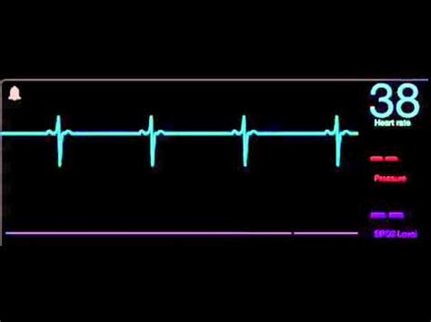 9 Bradicardia sinusal - YouTube