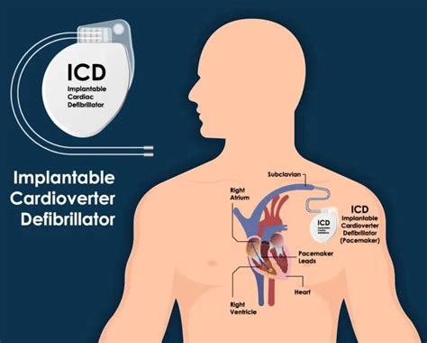 Implantable Cardioverter Defibrillator (ICD)