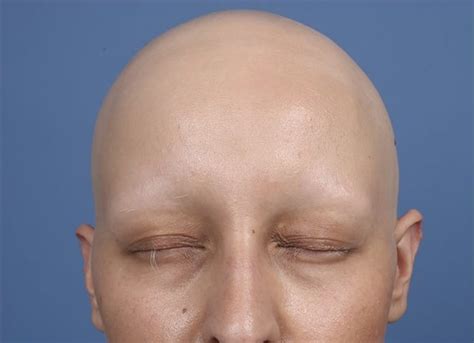 Alopecia Areata: Causes, Treatments, Breakthroughs | 2020 Guide