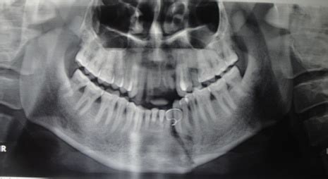 Mandibular Fracture X Ray